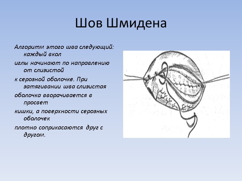 Шов Шмидена Алгоритм этого шва следующий: каждый вкол иглы начинают по направлению от слизистой